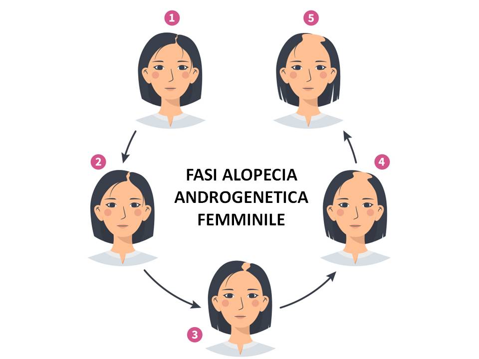 FASI ALOPECIA FEMMINILE