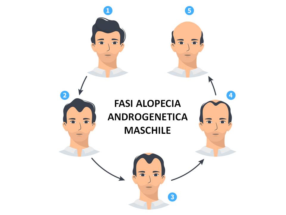 FASI ALOPECIA MASCHILE