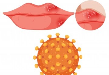 Herpes labiale: sintomi, rimedi e prevenzione