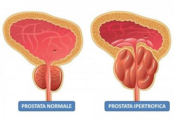 Ipertrofia Prostatica Benigna o Prostata Ingrossata: sintomi, cause e cure efficaci